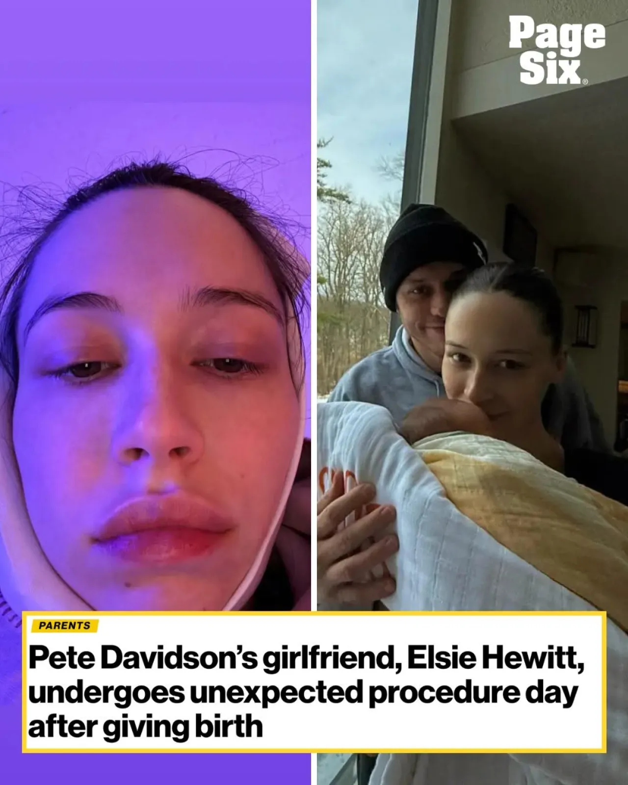 Pete Davidson's Girlfriend Elsie Hewitt Shares Post-Birth Wisdom Tooth Ordeal
